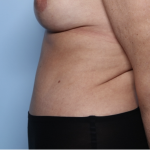 Tummy Tuck Before & After Patient #34291